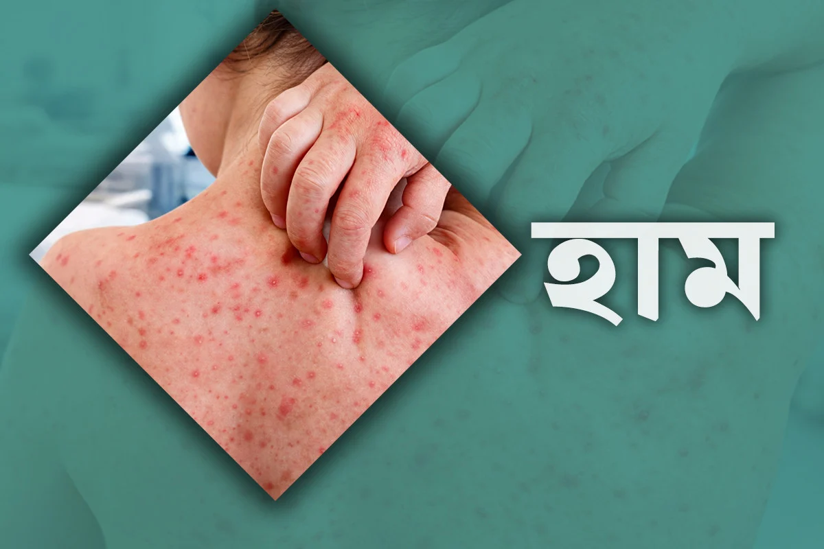 বগুড়ায় হামের উপসর্গ নিয়ে আরও এক শিশুর মৃত্যু
